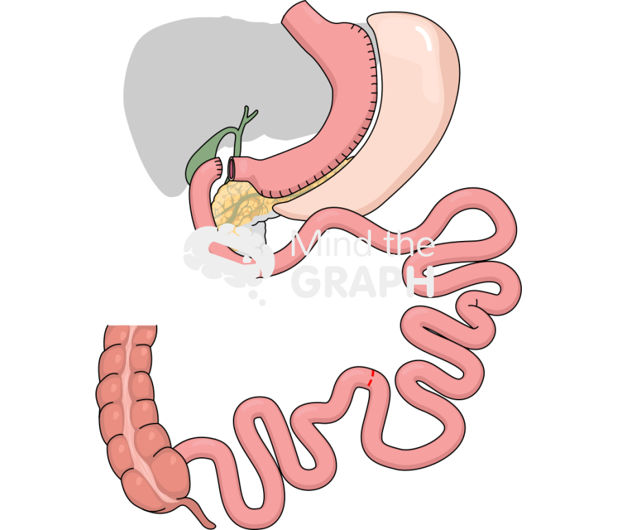 Sadis gastrectomy procedure Icons, Symbols, Pictures, and Images